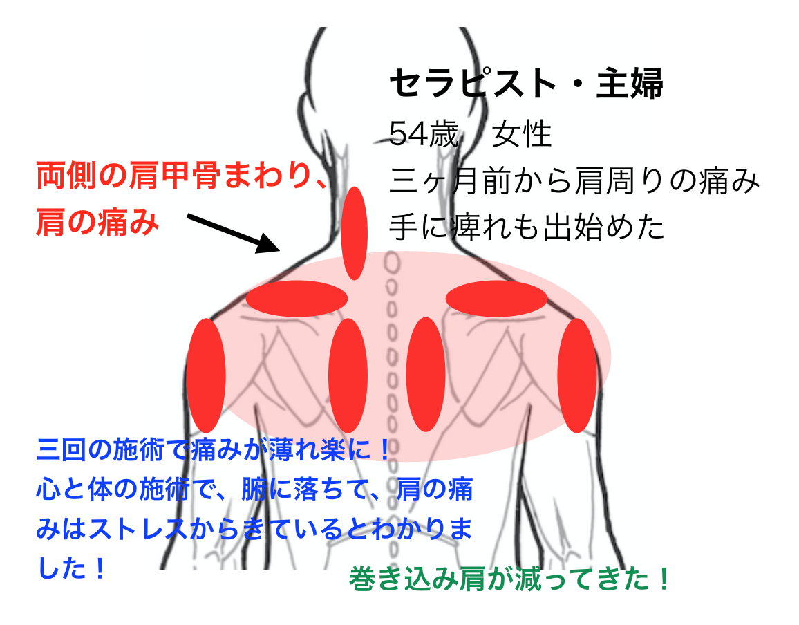 首 から 肩 にかけて の 痛み 左