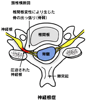 頸椎性神経根症